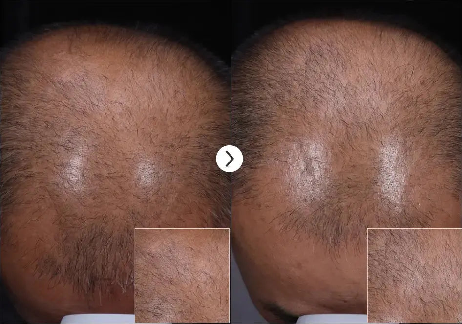 HAIRLOPECIA MESO COMPLEX RIBESKIN