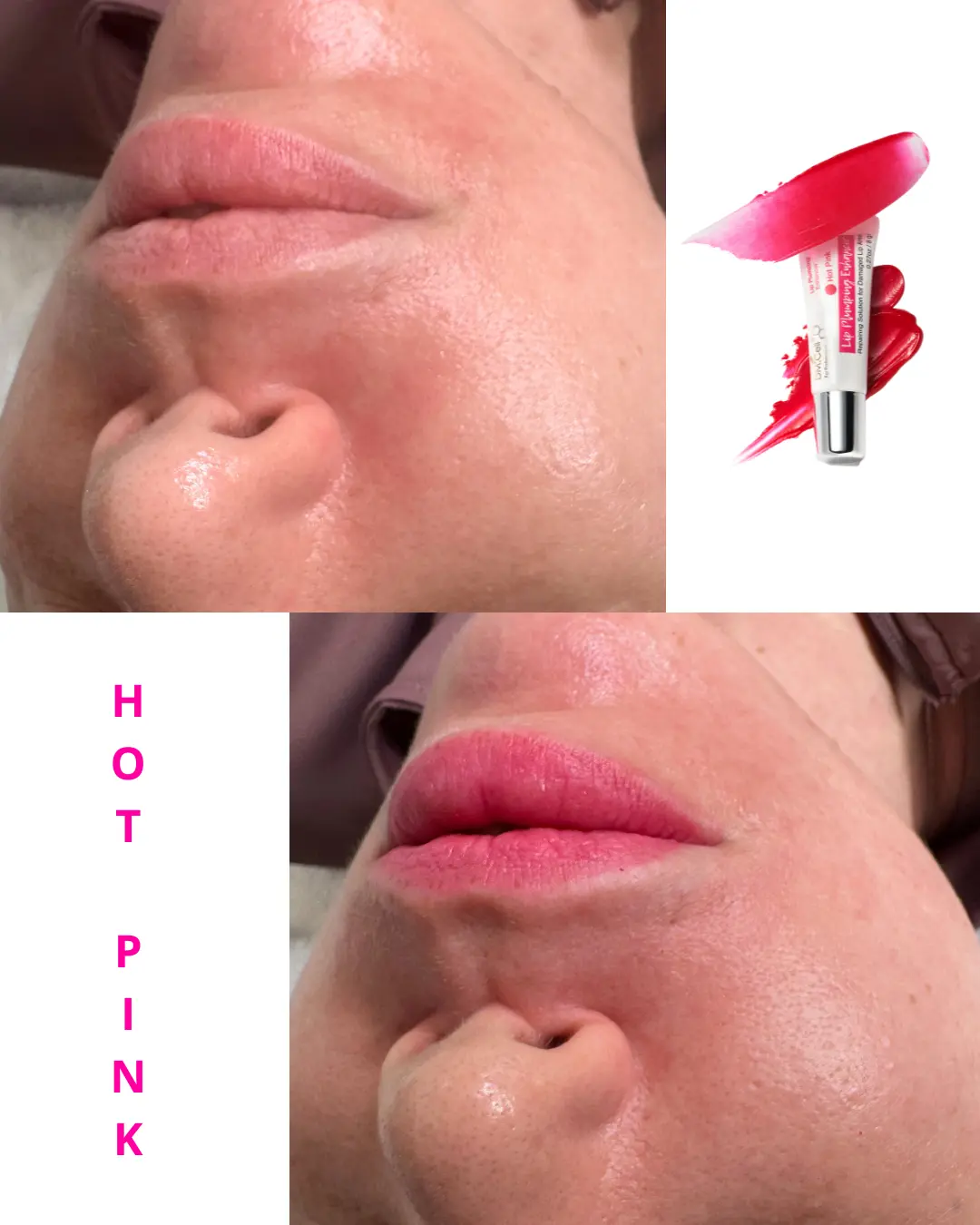 Lip Plumping Enhancer – BB Lips DM CELL