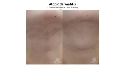 SOONSU SHINING PEEL- TCA 35%