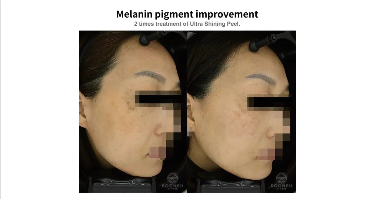 SOONSU SHINING PEEL- TCA 35%