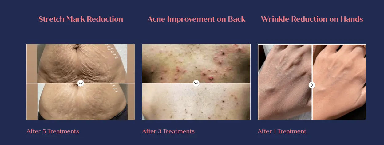 CO2 CARBOXY THERAPY RIBESKIN