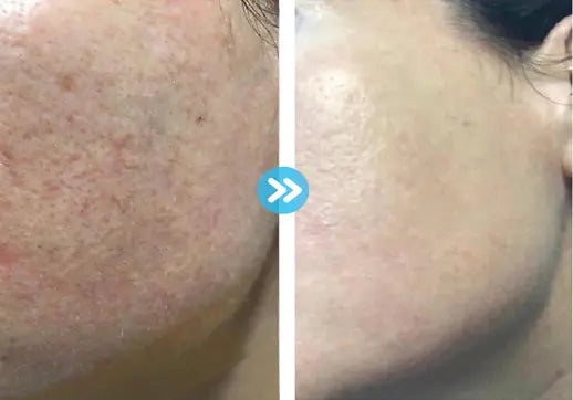 CO2 CARBOXY THERAPY RIBESKIN